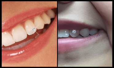 Tooth Piercing: Ultimate Guide with Top Tips